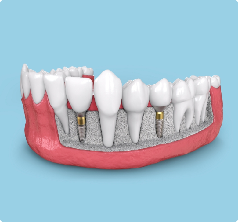 Les implants dentaires : une option durable et naturelle
